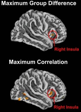 Los círculos en rojo indican dónde se produjo el máximo efecto de la meditación en el cerebro. Imagen superior: Mayor girificación de las personas que meditaban, en comparación con las personas que no lo hacían. Imagen inferior: Relación positiva entre la