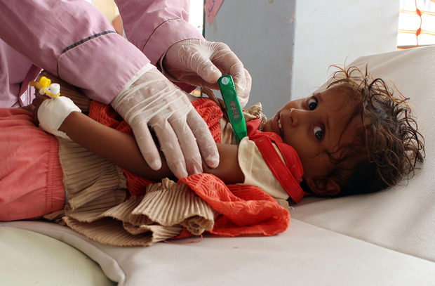 Yemen niña child enfermedad disease