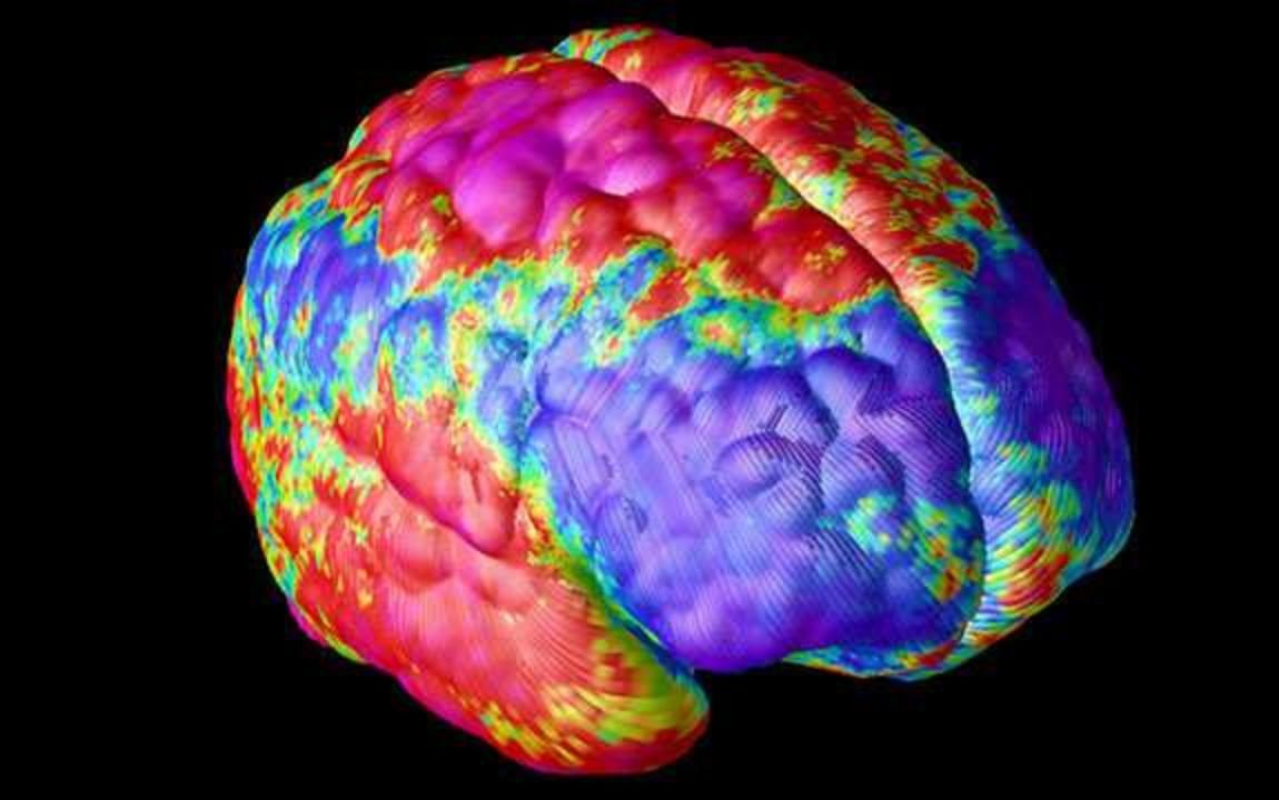 A false colour image of a brain of a person with schizophrenia. Credit: NIH