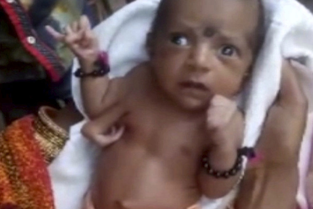 bebe en India nació con tres manos