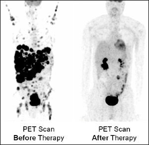 escaner PET cáncer