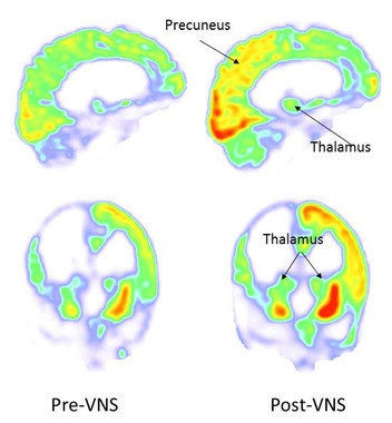 Imágenes de antes y después de la estimulación del nervio vago (a la derecha, post-VNS). Después de la estimulación, el metabolismo aumentó en el córtex parietal y occipital derecho, tálamo y cuerpo estriado.