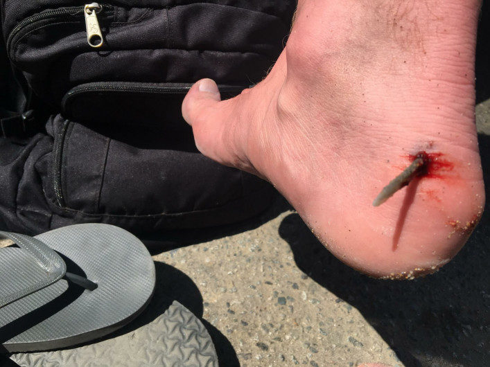 A stinger is lodged in a foot of a victim in Huntington Beach a few weeks ago.