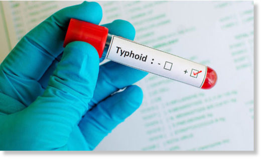 typhus,tifus