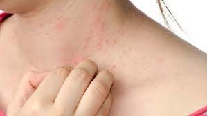 eczema