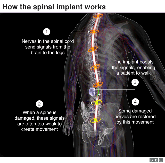 spinal implant,implante de espina