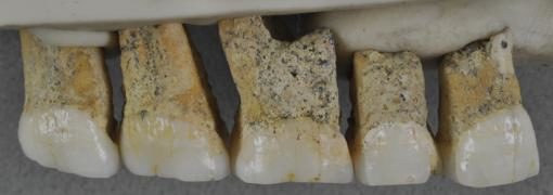 Dientes superiores derechos de un Homo luzonensis. De izquierda a derecha: dos premolares y tres molares.