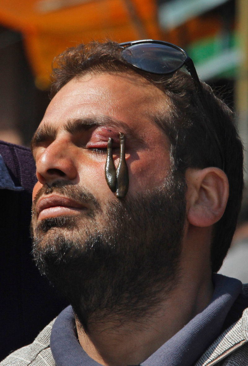Terapia de sanguijuelas (AP)