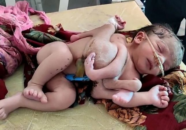 Una mujer da a luz a un bebé con cuatro piernas y tres manos en La India