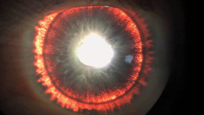 Eye disease