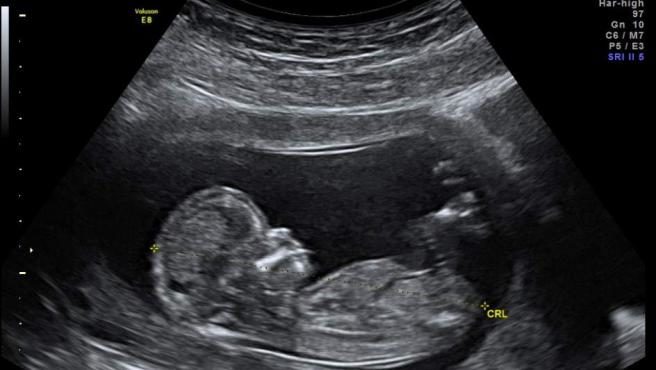 Eslovaquia obligará a ver una imagen y escuchar los latidos del feto a las mujeres que quieran abortar