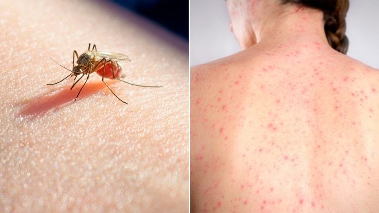 Crisis sanitaria en Argentina: ya son casi 3 mil los casos de dengue y 158 los de sarampión