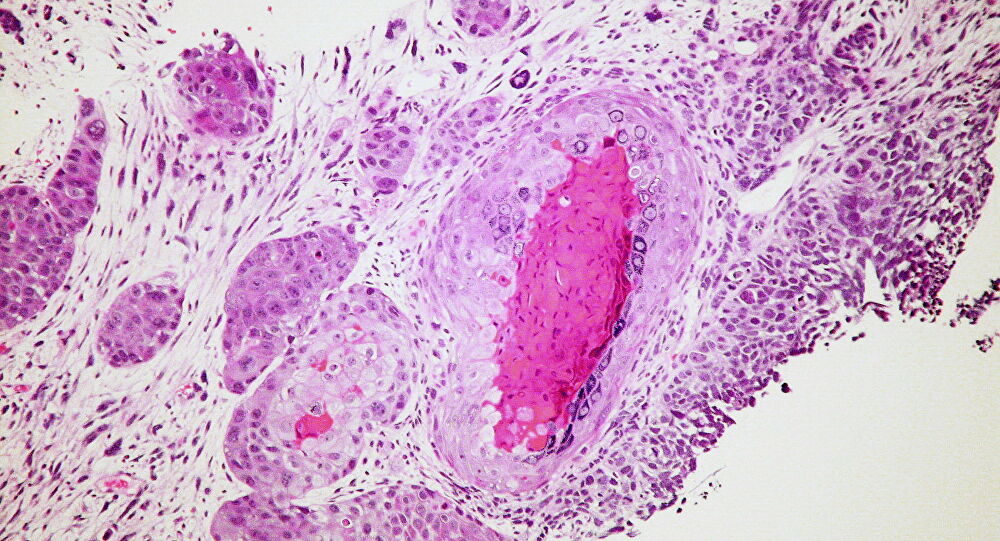 Cancer cells