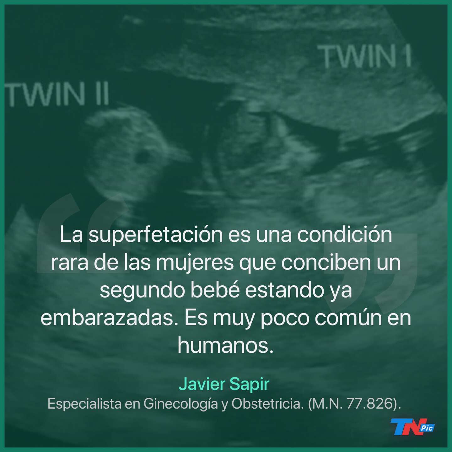 Clic para aumentar Caso,Superfetación,embarazada