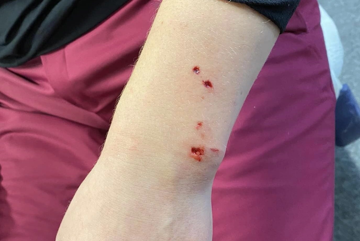 The bite wound on the arm of the female skier, identified only as ‘Sofia’ on social media