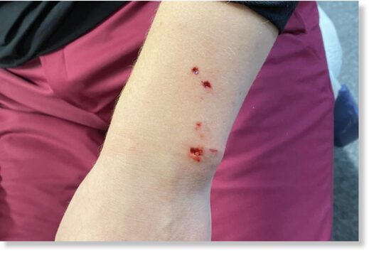 The bite wound on the arm of the female skier, identified only as ‘Sofia’ on social media