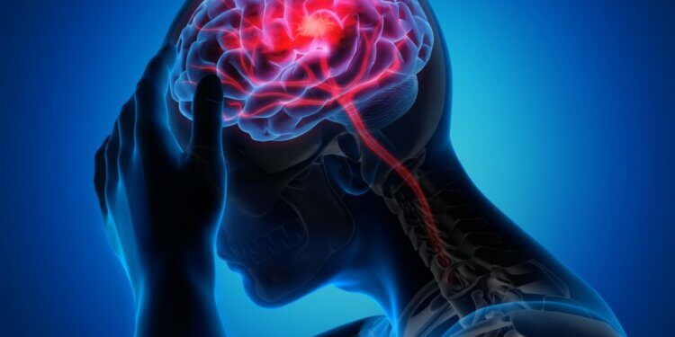 brain graphic headache stroke