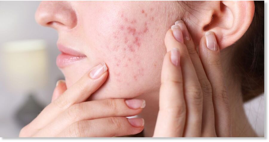 acne