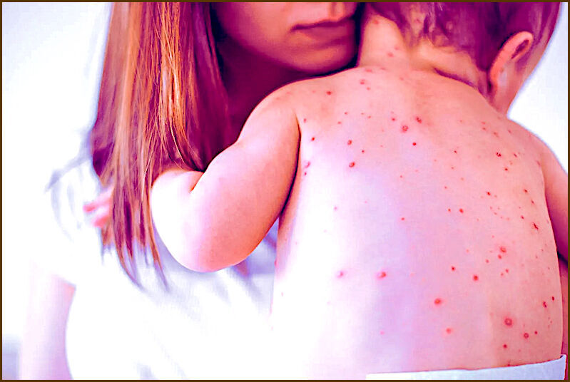 child measles