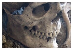 Clic para aumentar Skeleton with evidence of bladed weapon injuries.
