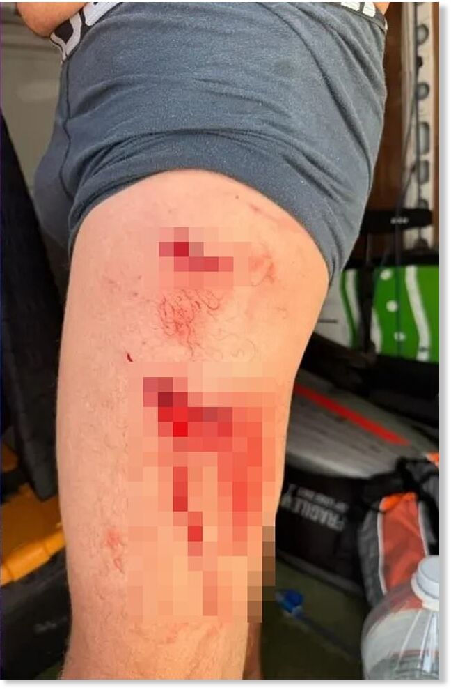 Although he was able to fight off the shark, the man sustained two gruesome bites just below his knees