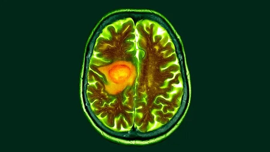 Clic para aumentar brain cancer cat scan