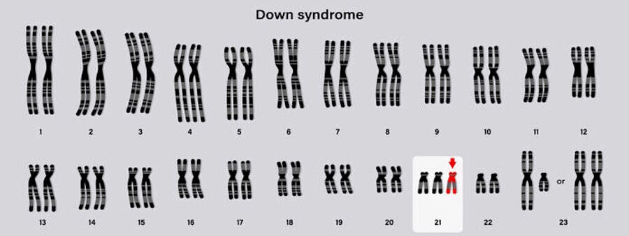 down syndrome karyotype missing chromosome
