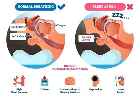 sleep apnea