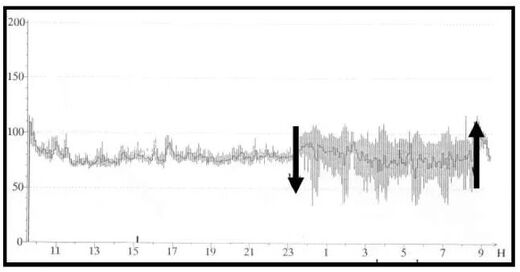 pathological HRV