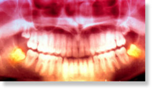 radiografías dentales panorámicas