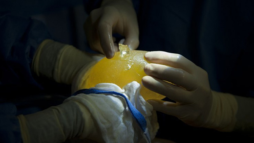 implante mamario