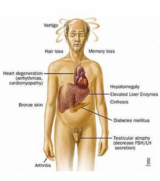 síntomas hemocromatosis