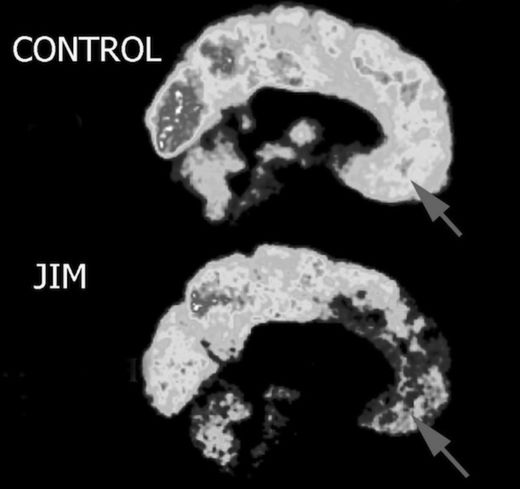 Jim Fallon's brain compared to a normal brain